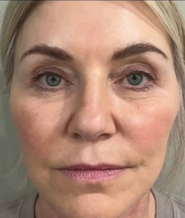 The same patient after a deep plane face and neck lift with fat grafting.