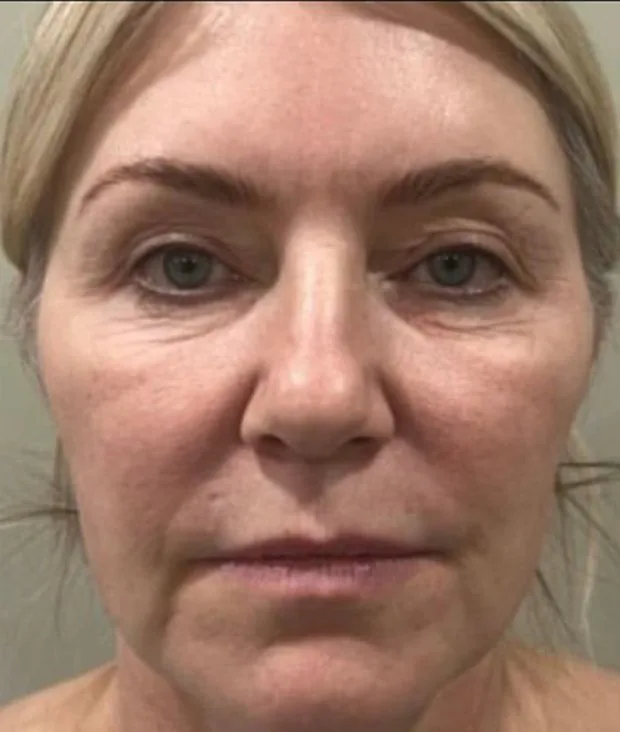 Patient before a deep plane face and neck lift with fat grafting.