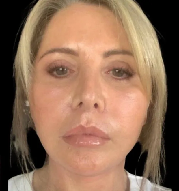 The same patient after surgery