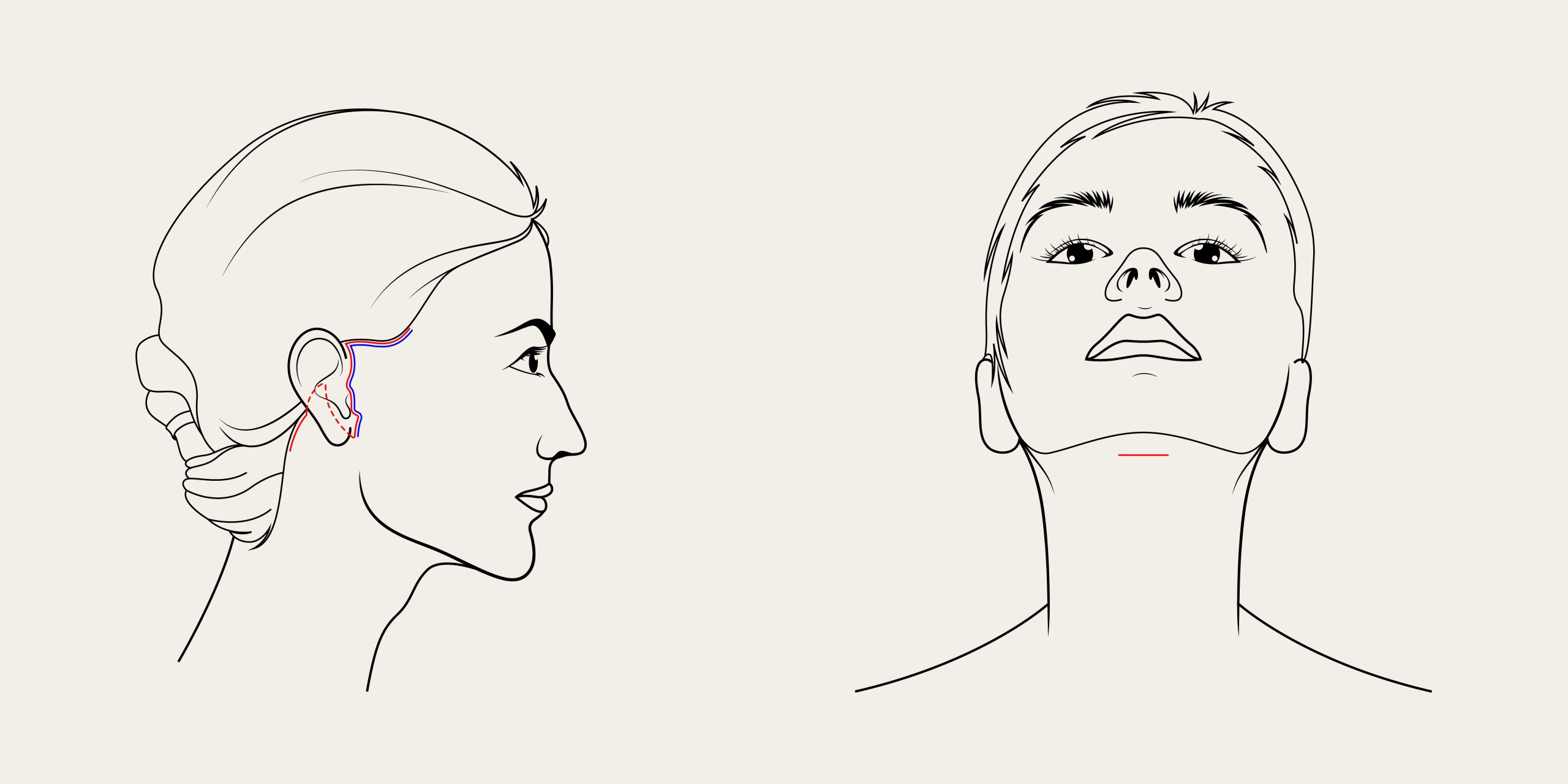 Line drawings of the incision lines around the ear and under the chin