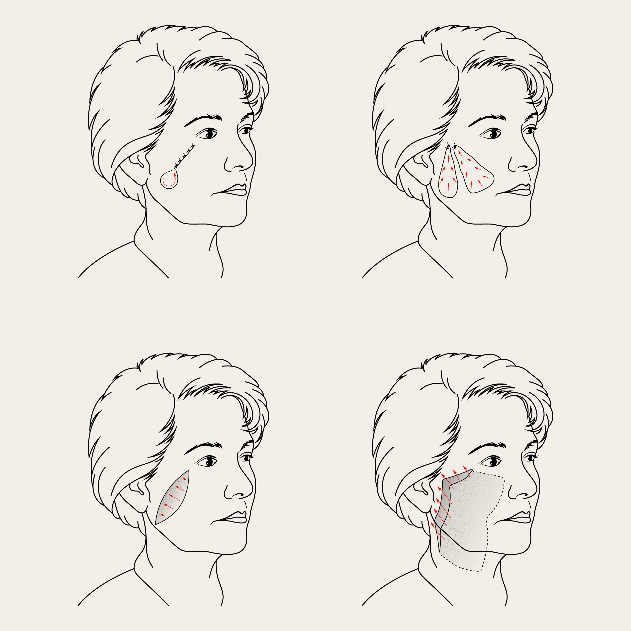 Four line drawings of a woman’s face, each marking a different SMAS technique on the cheek