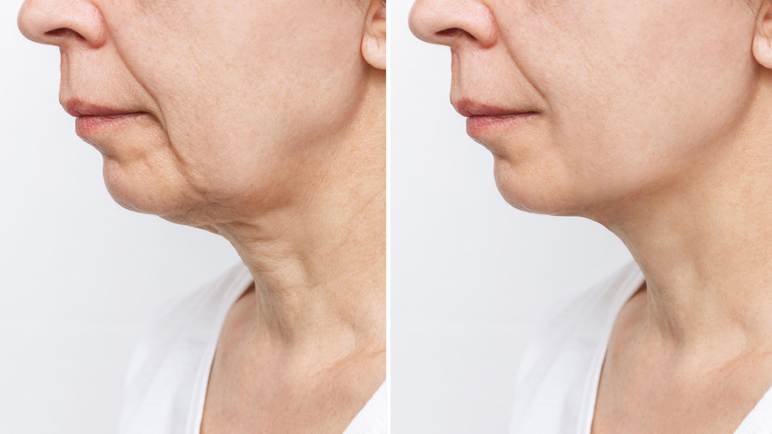 Illustration showing the jawline, jowls and neck as one connected treatment area in facial rejuvenation surgery