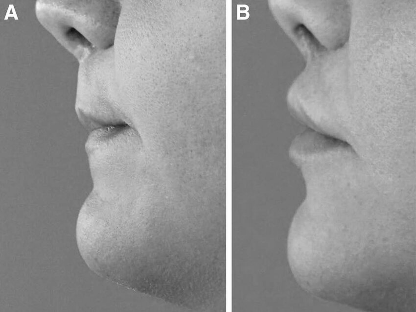 Long Upper lio