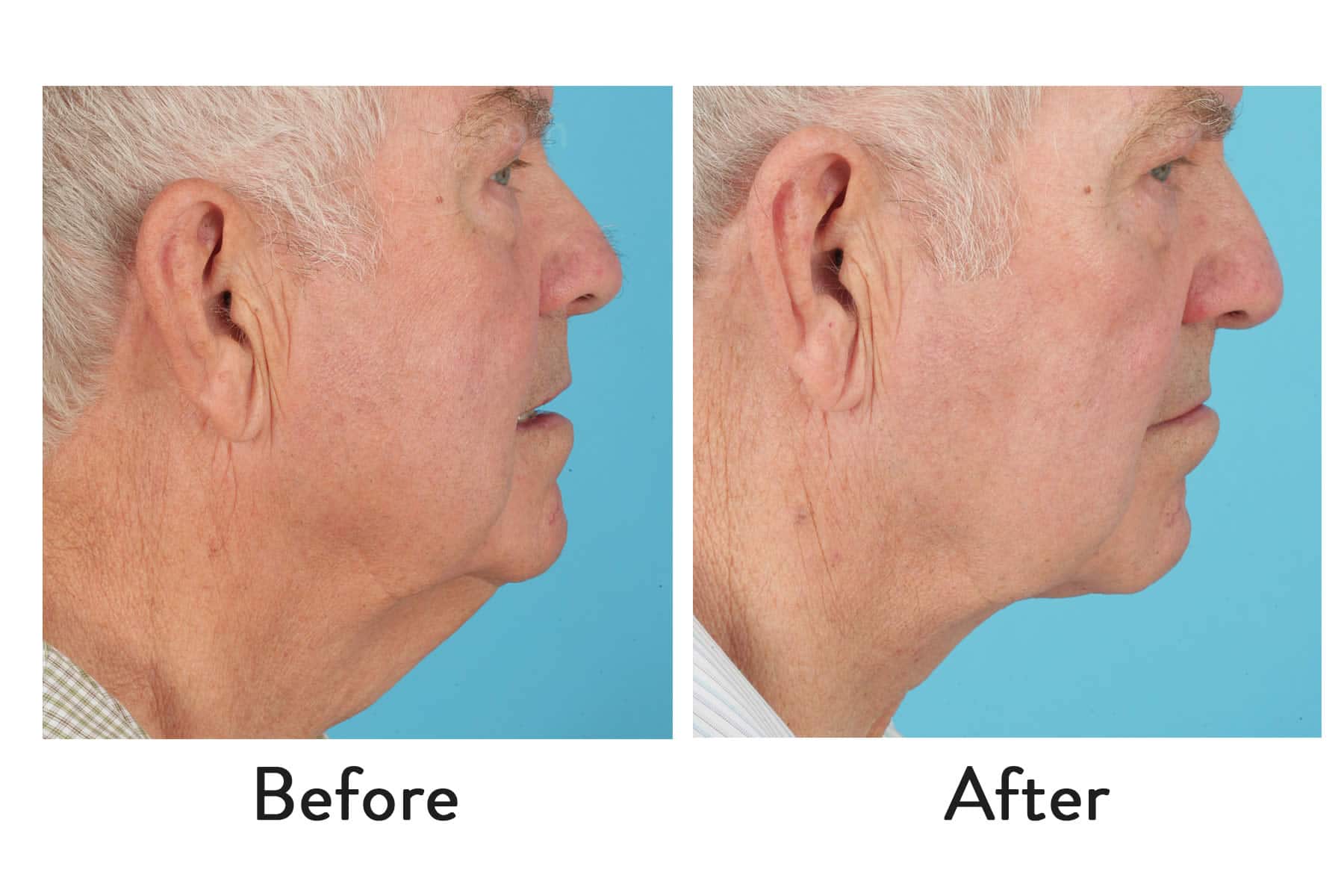 Before and after neck contour comparison showing improved definition below the jawline