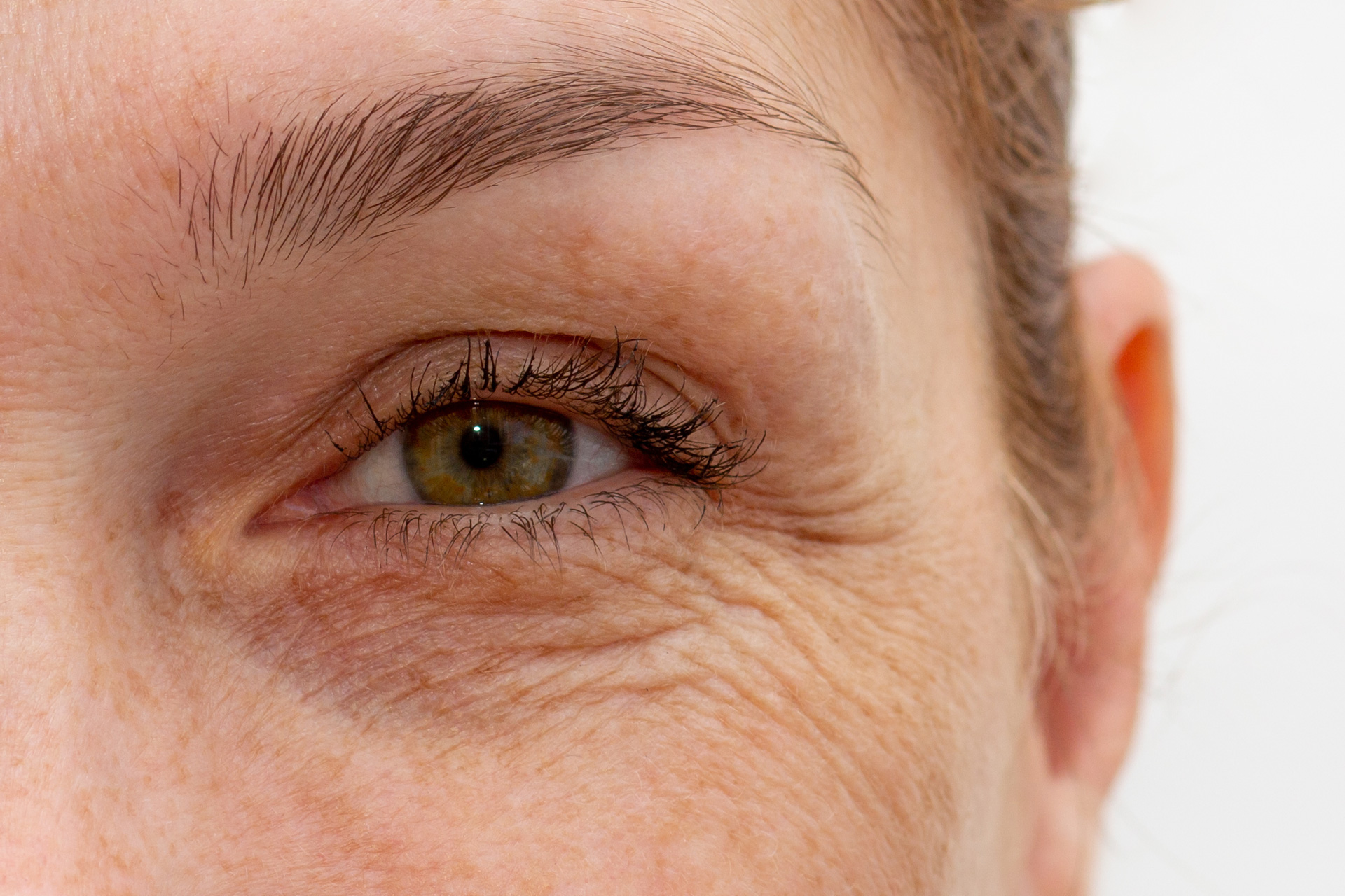 upper eyelids
