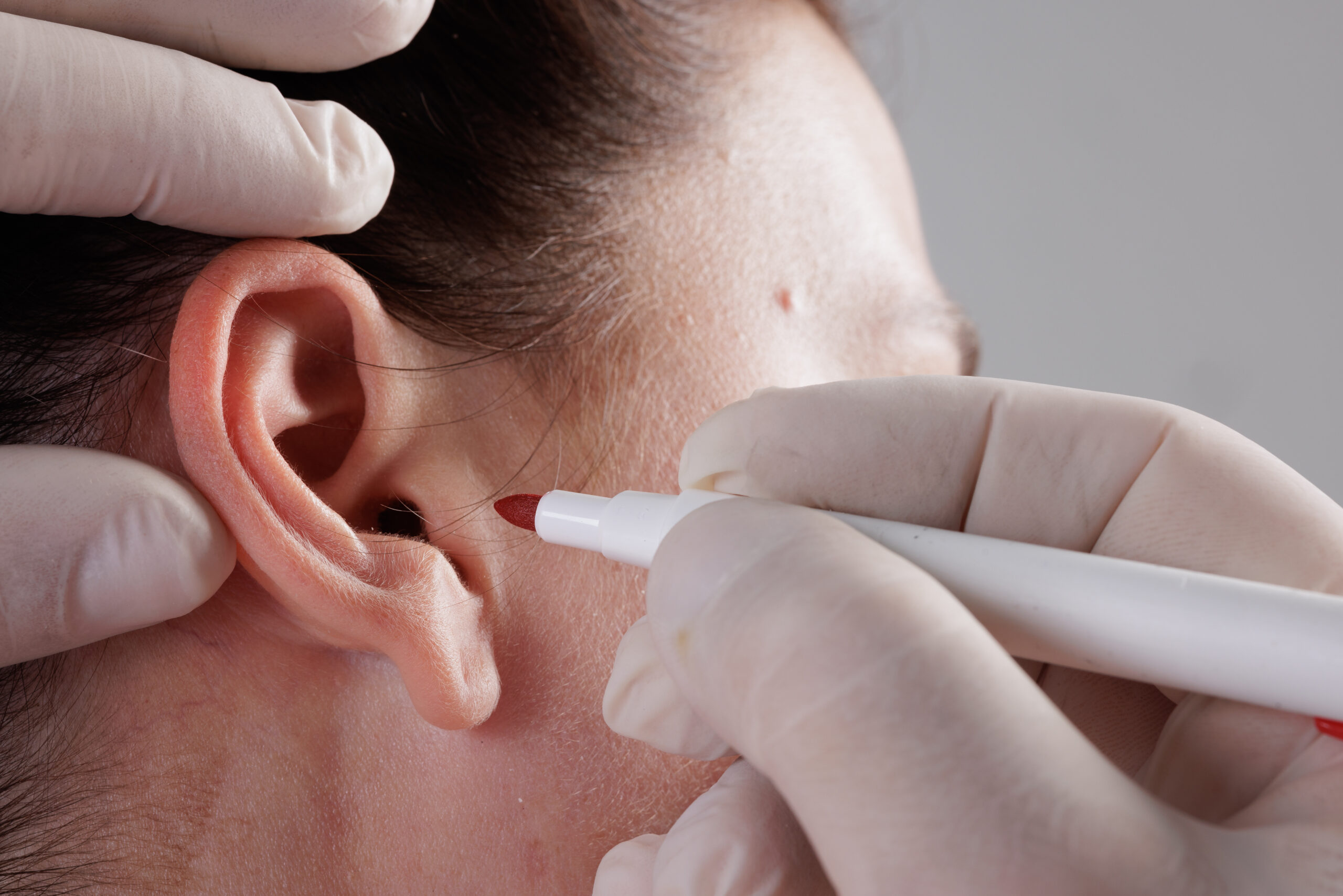 The doctor surgeon is preparing for the operation Otoplasty, Ear plastic surgery, correction of protruding ears