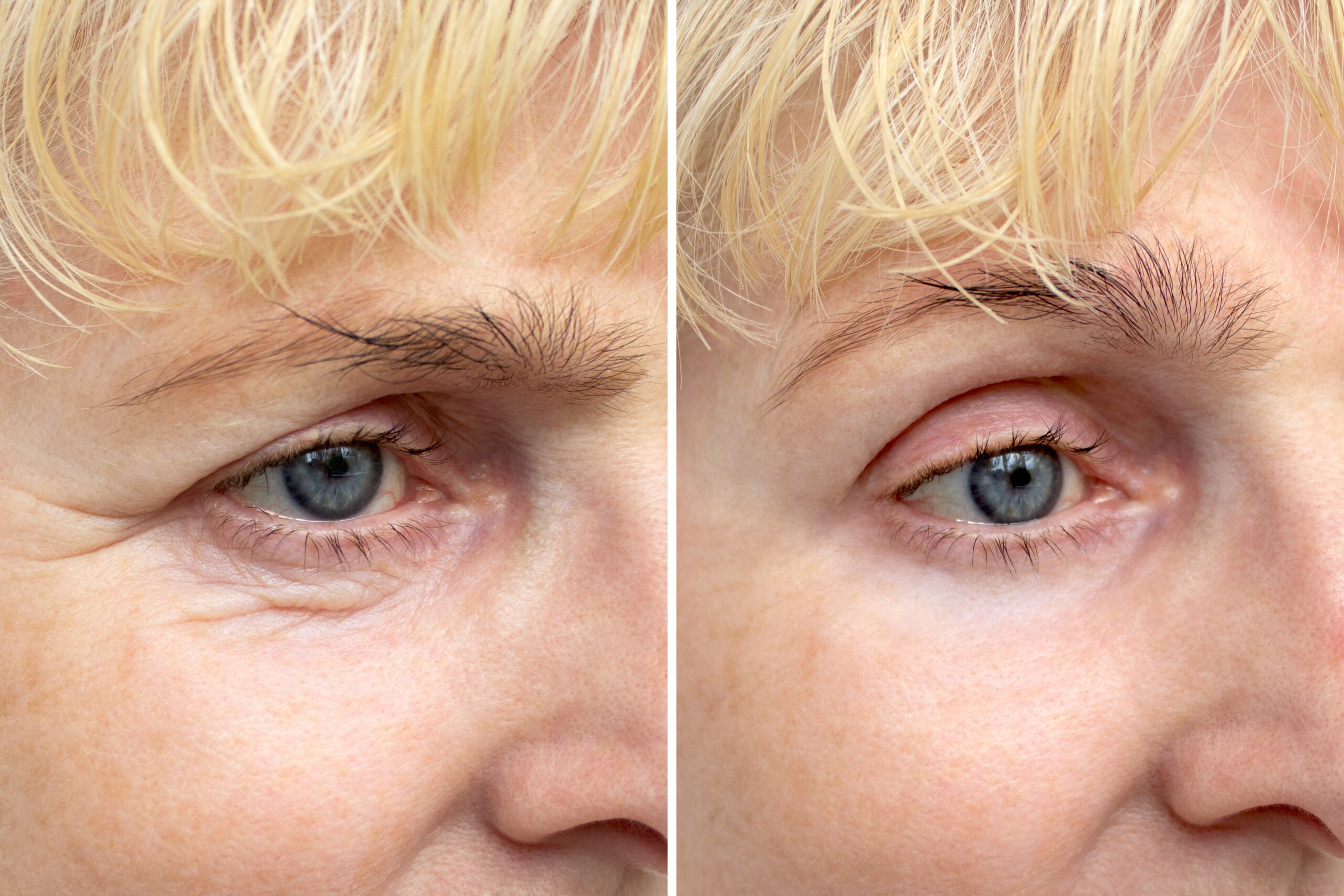 Close up of an elderly woman's eye before and after blepharoplasty Rejuvenation procedure, correction of the upper and lower eyelids Removing wrinkles and puffiness under the eyes Mesotherapy