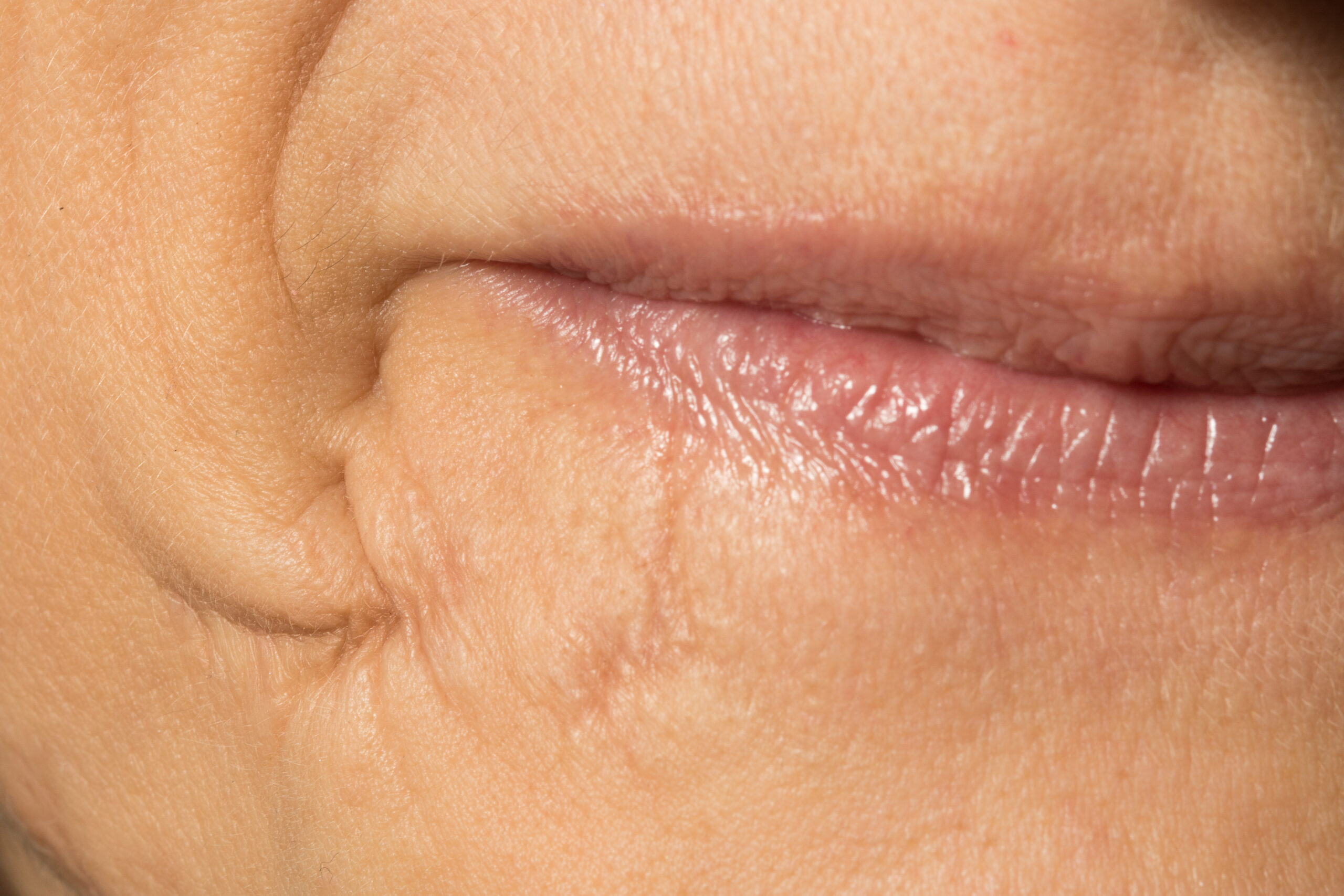 An extreme closeup view of an old and well healed scar by the lips of a Caucasian woman, healthcare and surgery concept