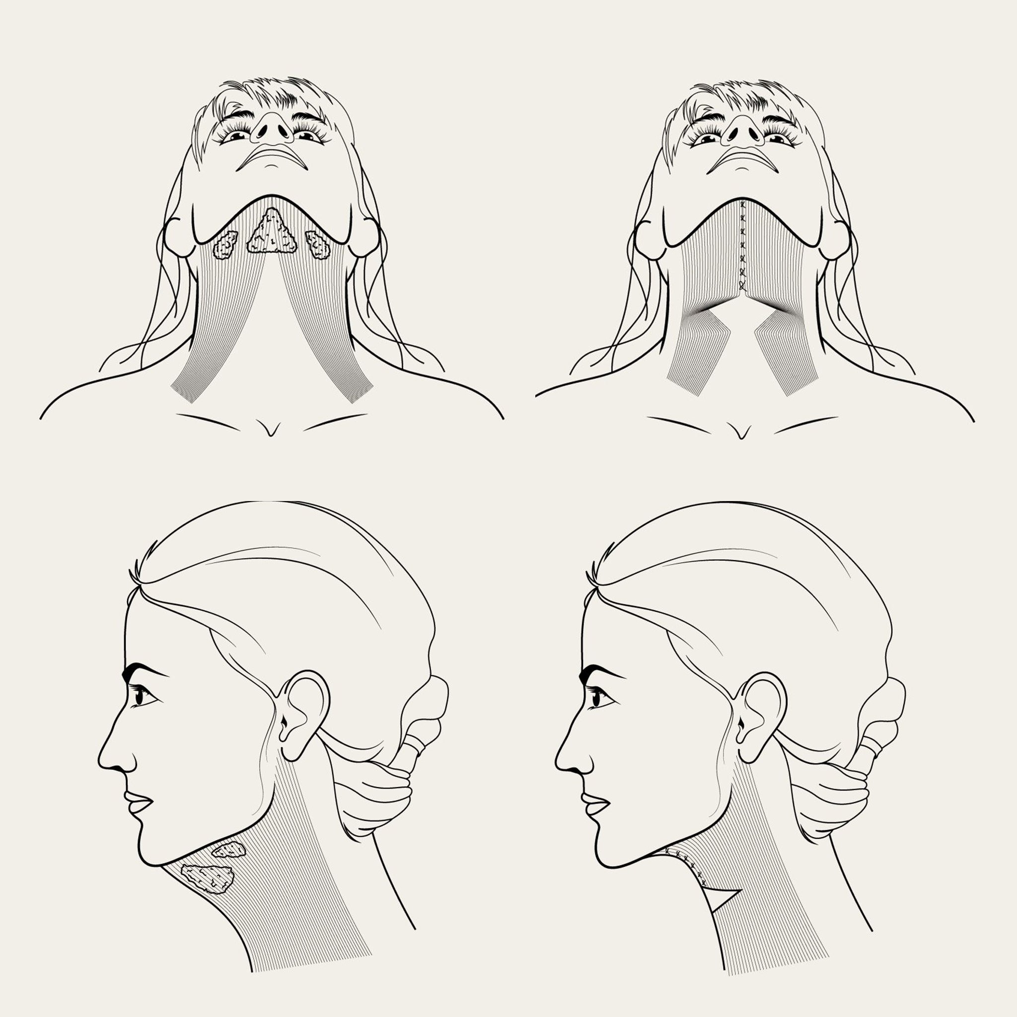 Line drawings of the neck from below and from the side, showing the neck muscle apart and then stitched together