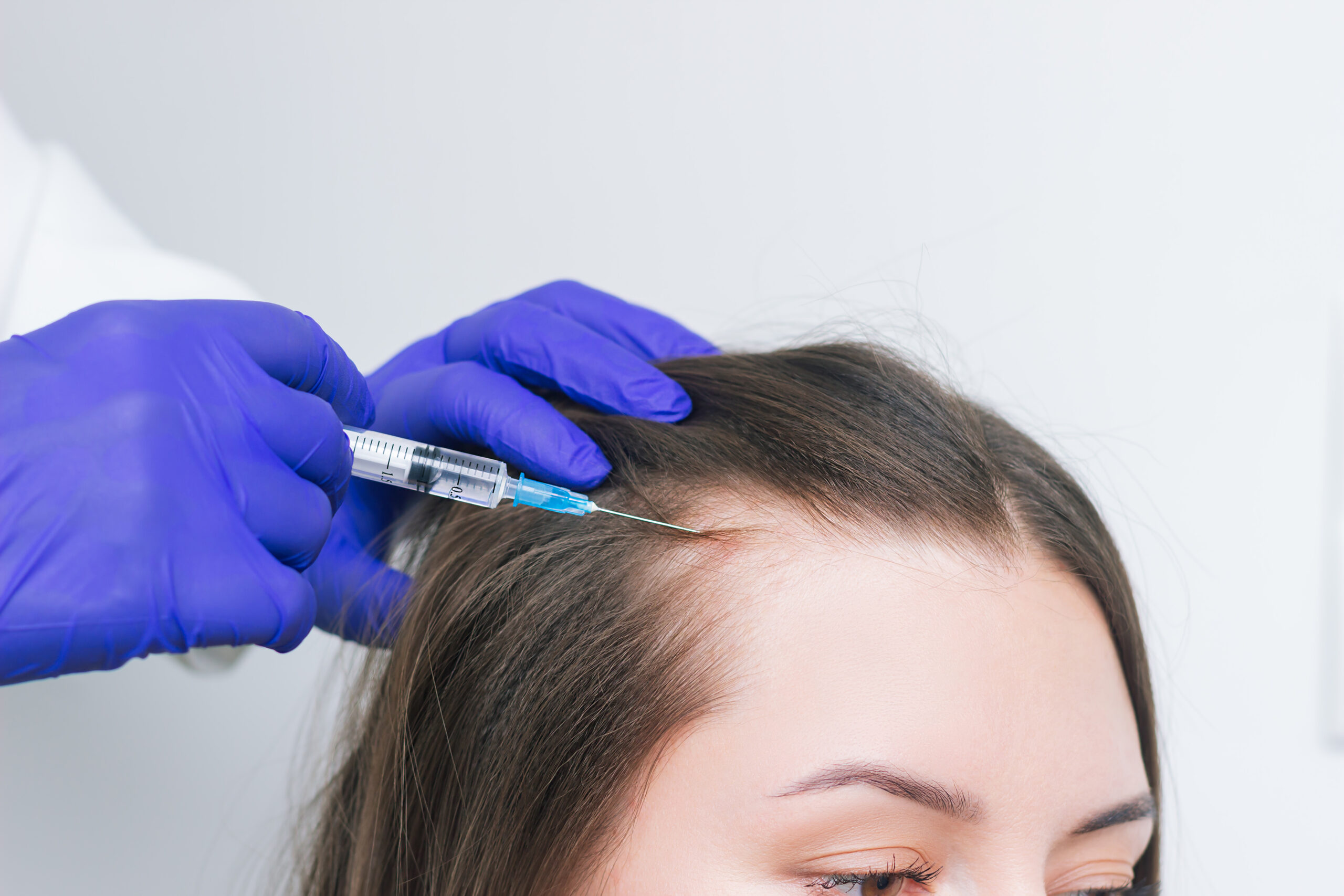 A young woman suffering for hair loss receiving injections into the scalp for hair growth PRP therapy for hair Loss Mesotherapy for hair growth