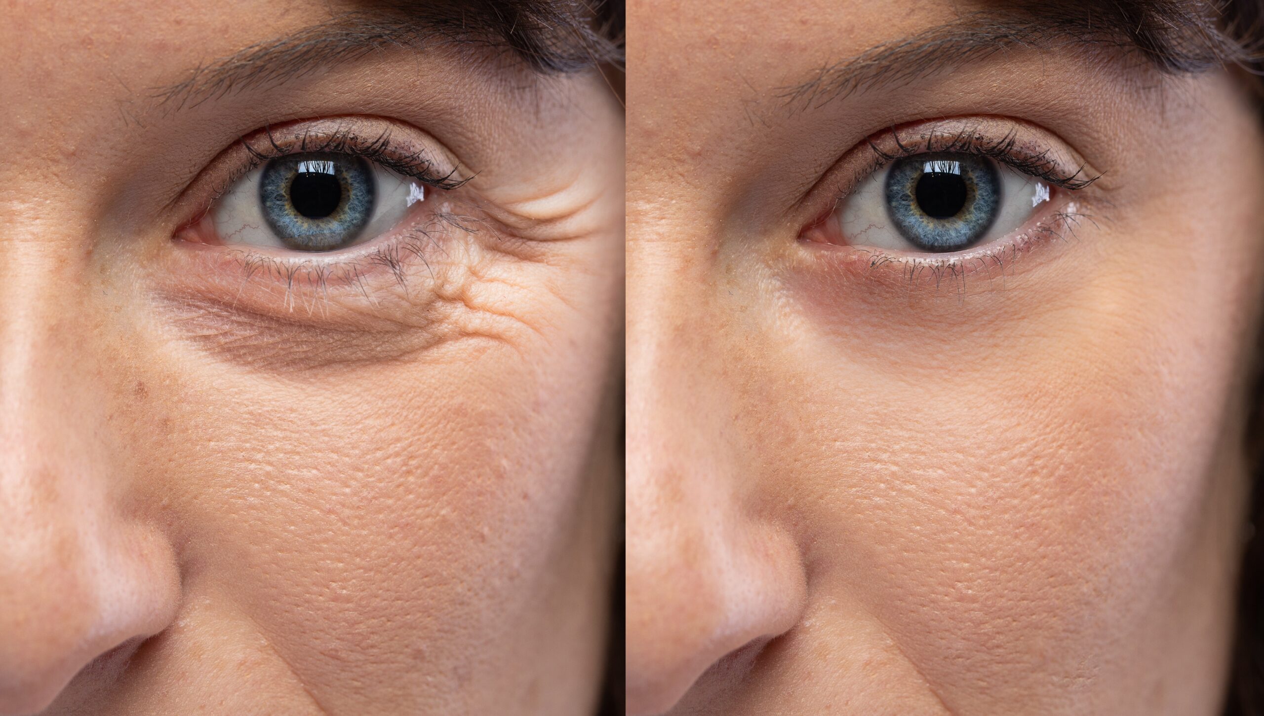 Woman eyes before and after an anti age treatment for wrinkles and crow's feet