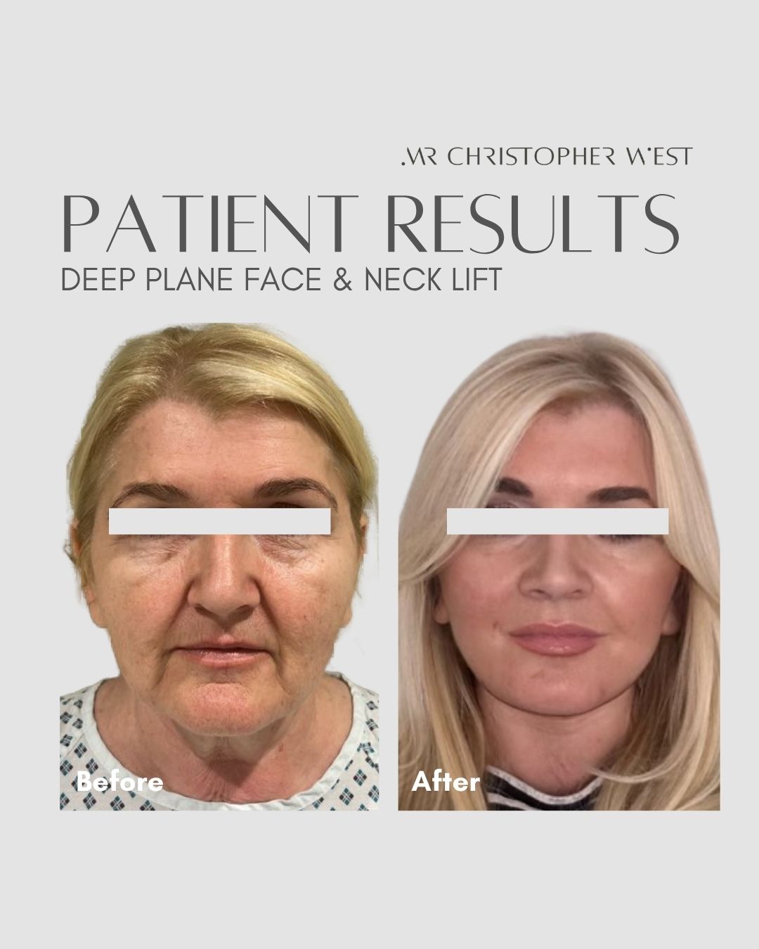 Placeholder for Mr Christopher West patient before and after images showing jawline and neck improvement after face and neck lift surgery