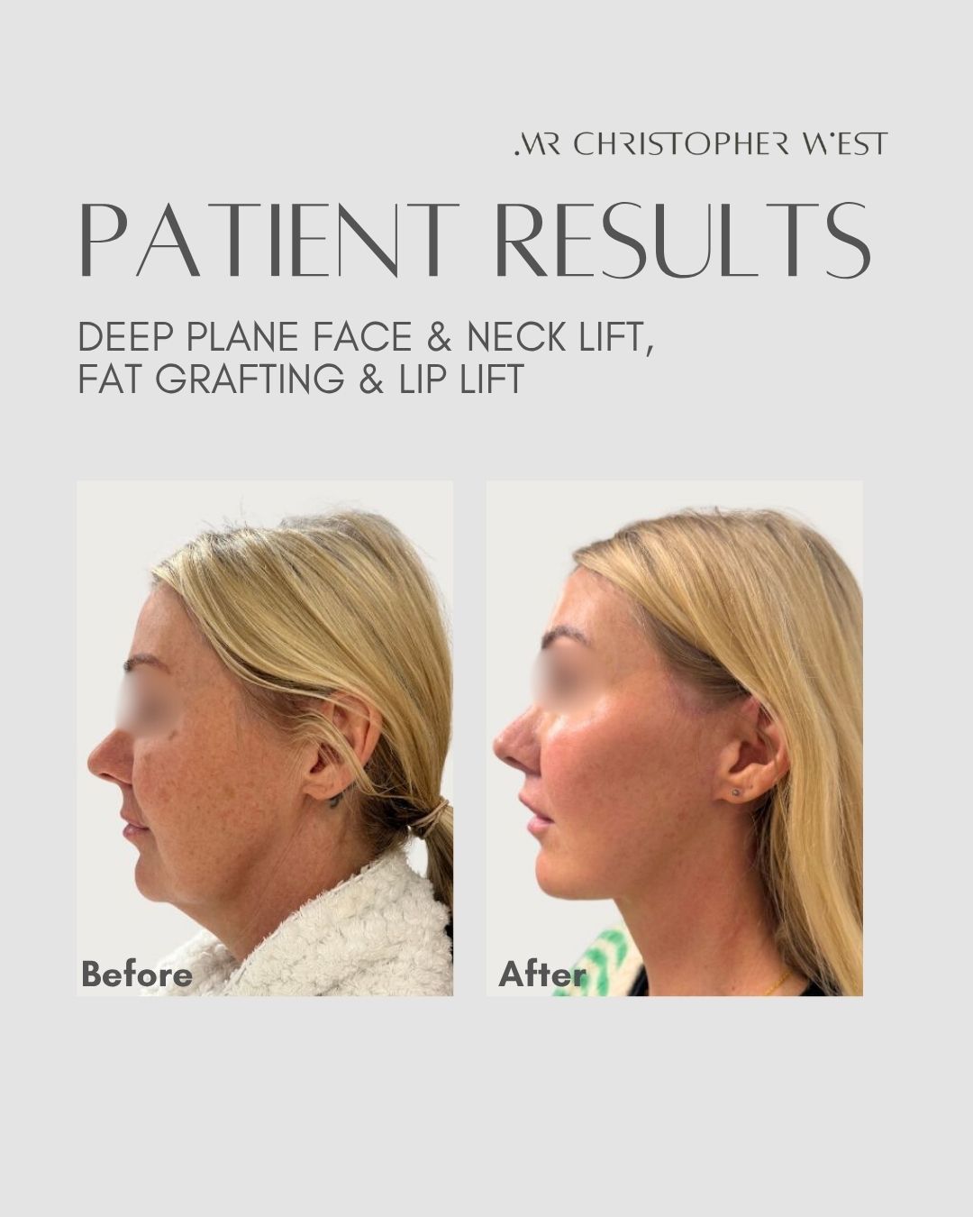 Placeholder for Mr Christopher West patient before and after images showing neck contour improvement below the jawline