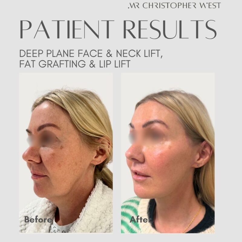 Why a neck lift Is often needed with a facelift