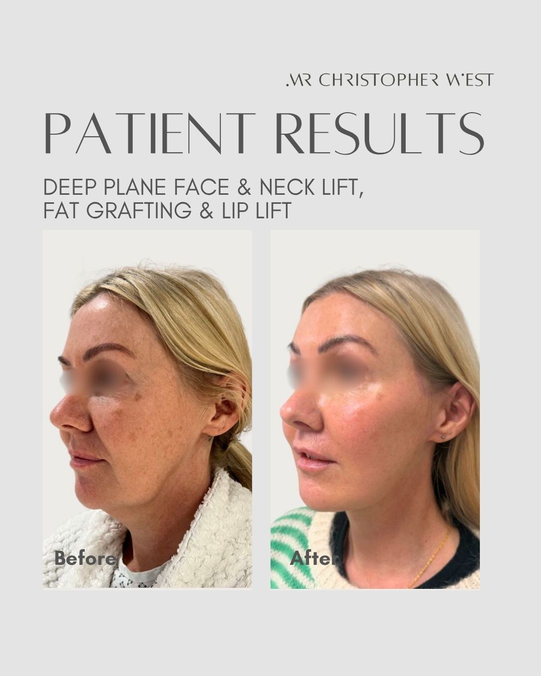 Why a neck lift Is often needed with a facelift