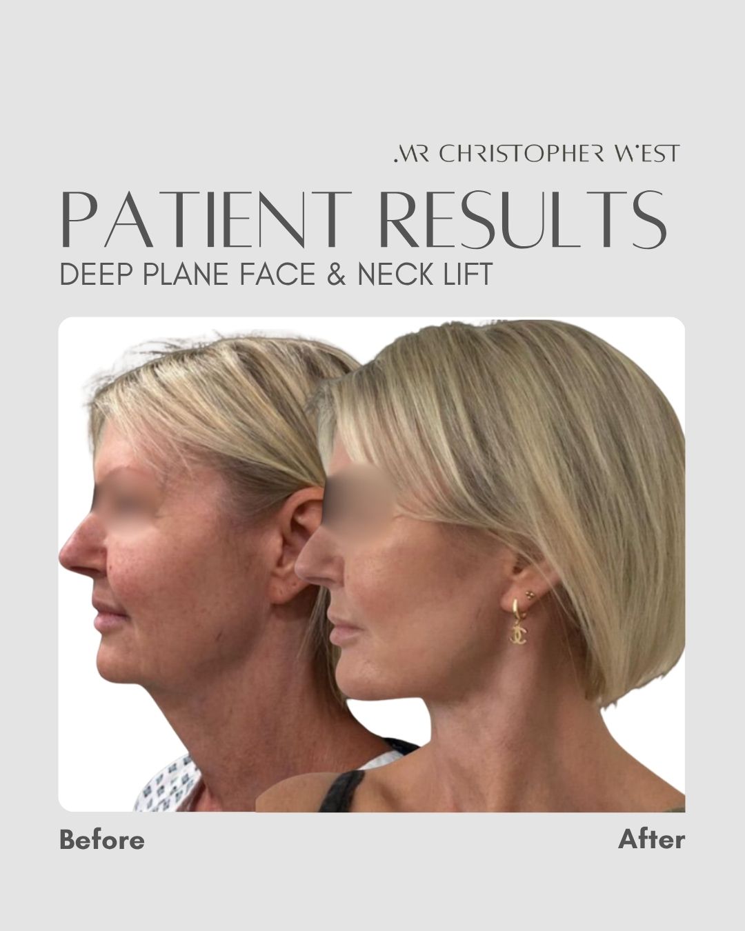 Placeholder for Mr Christopher West patient before and after images showing facelift and neck lift improvement